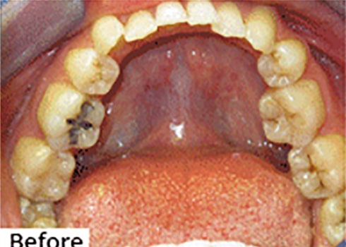 Before Image: Smile Makeover - front