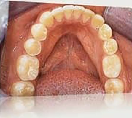 After Image: Smile Makeover - front