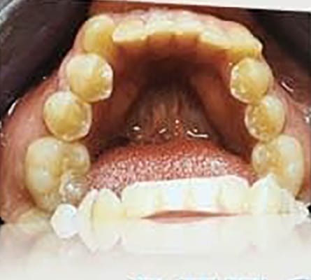 Before Image: Smile Makeover - front