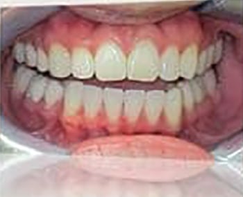 After Image: Smile Makeover - front