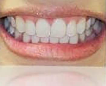 After Image: Smile Makeover - front