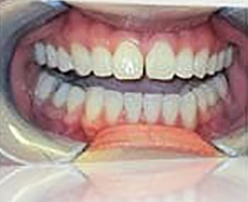 Before Image: Smile Makeover - front