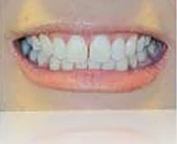 Before Image: Smile Makeover - front