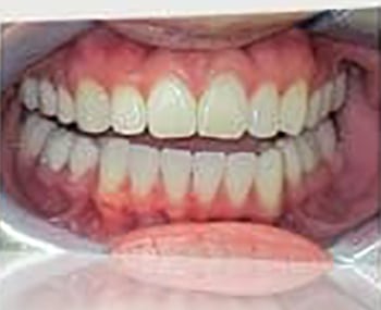 After Image: Smile Makeover - front