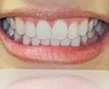 After Image: Smile Makeover - front