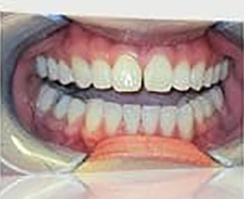 Before Image: Smile Makeover - front