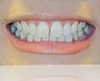Before Image: Smile Makeover - front